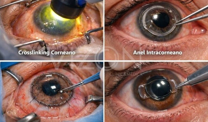 Cirurgia do Olho Jefferson Vaz - Implante do Anel intracorneano