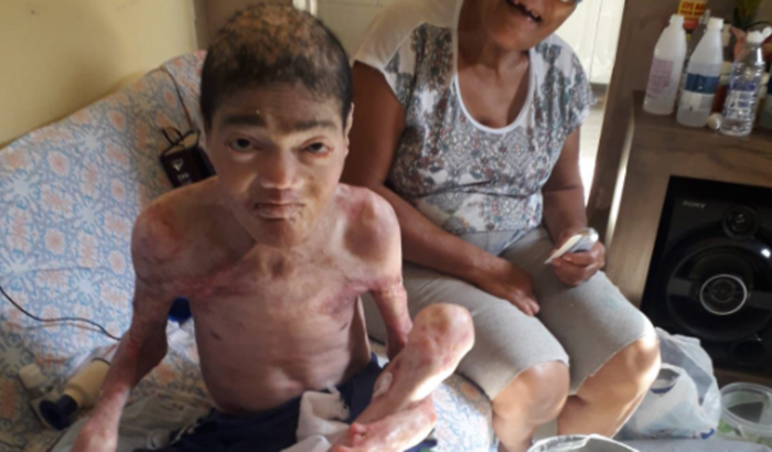 Epidermólise Bolhosa - Vanderson de Jesus Silva