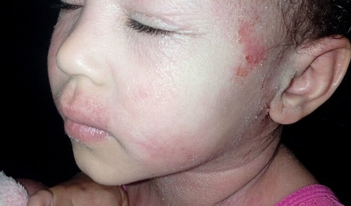 Tratamento para dermatite atópica com imunobiológicos Helena