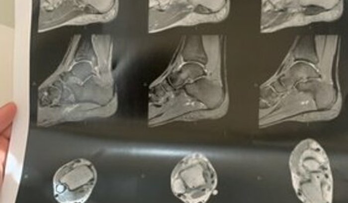 CIRURGIA TORNOZELO 