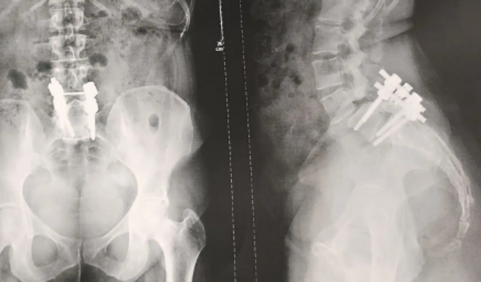 Cirurgia de coluna de Marineuza dos Santos Araújo 