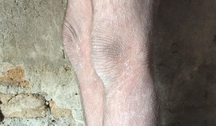 TRATAMENTO DE DOENÇA ERITROQUERATODERMIA