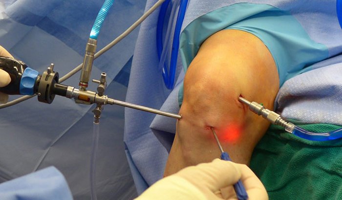 Cirurgia de joelho - Ligamento Cruzado Anterior + Menisco