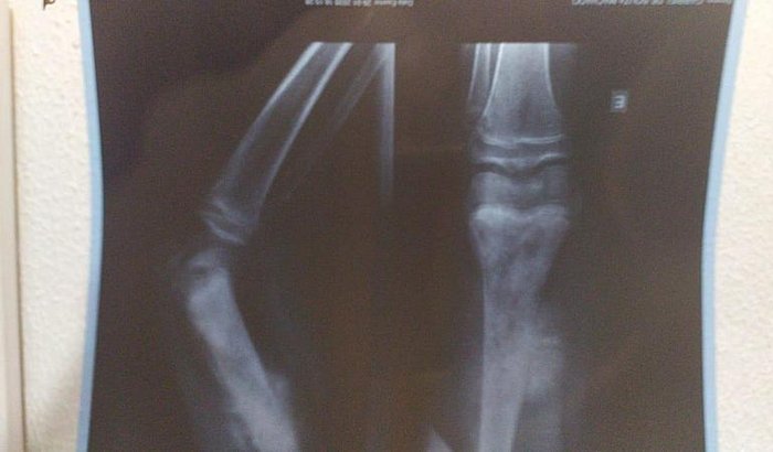 Ajuda Para Gabriel (Câncer Na Perna)