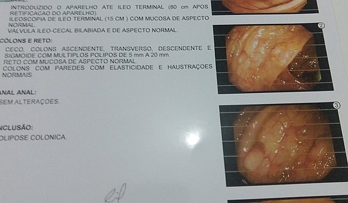 Cirurgia de retirada de todo intestino grosso
